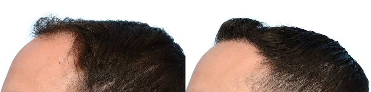 Hair Restoration Before & After Gallery - Patient 427118 - Image 4