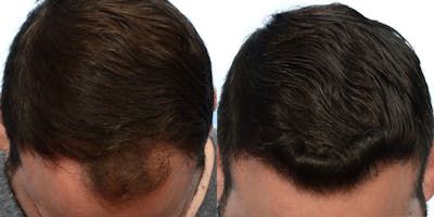 Hair Restoration Before & After Gallery - Patient 427118 - Image 1