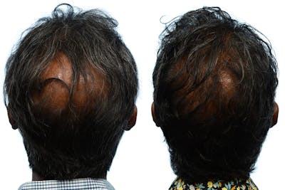 Hair Restoration Before & After Gallery - Patient 353599 - Image 1