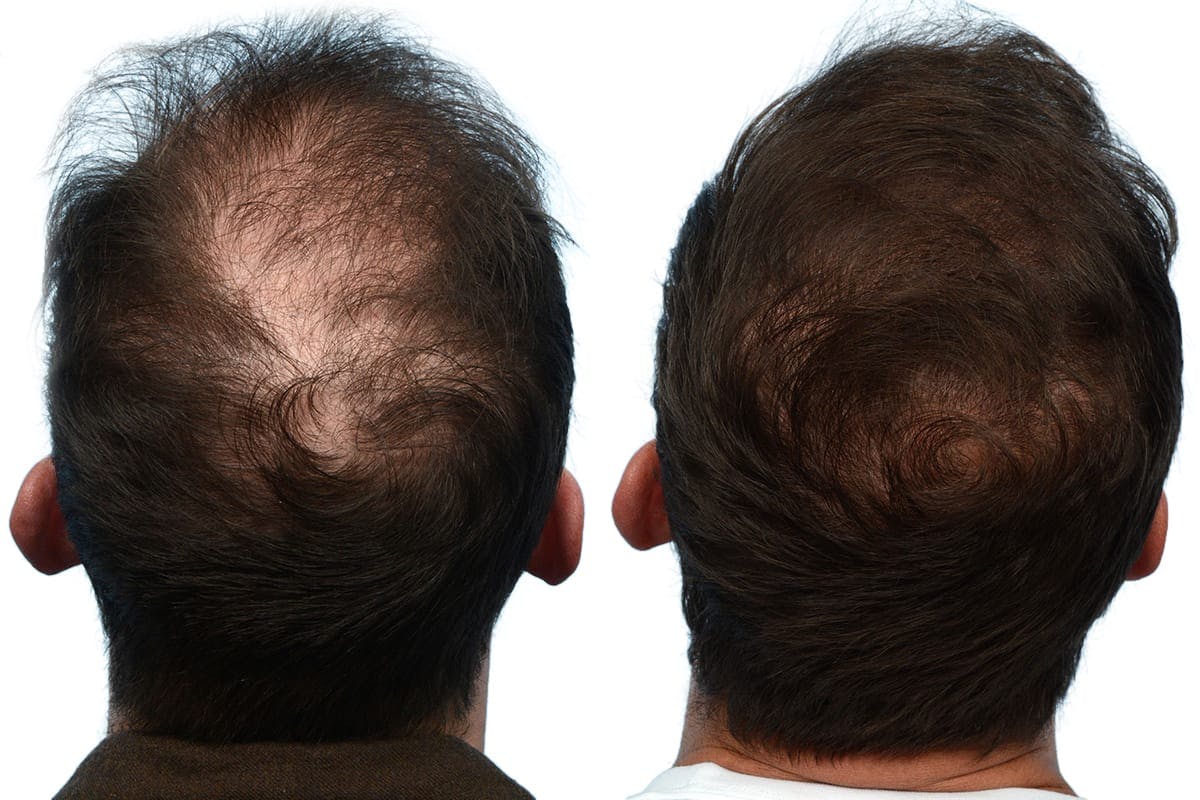 FUE Hair Transplant Before & After Gallery - Patient 374313 - Image 1