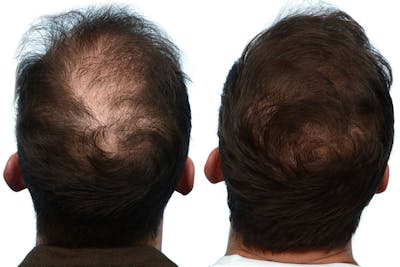 Hair Restoration Before & After Gallery - Patient 368855 - Image 1