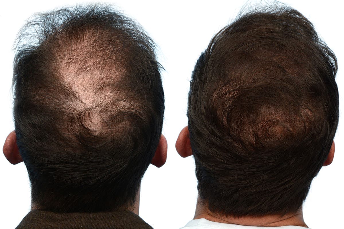 Hair Restoration Before & After Gallery - Patient 368855 - Image 1
