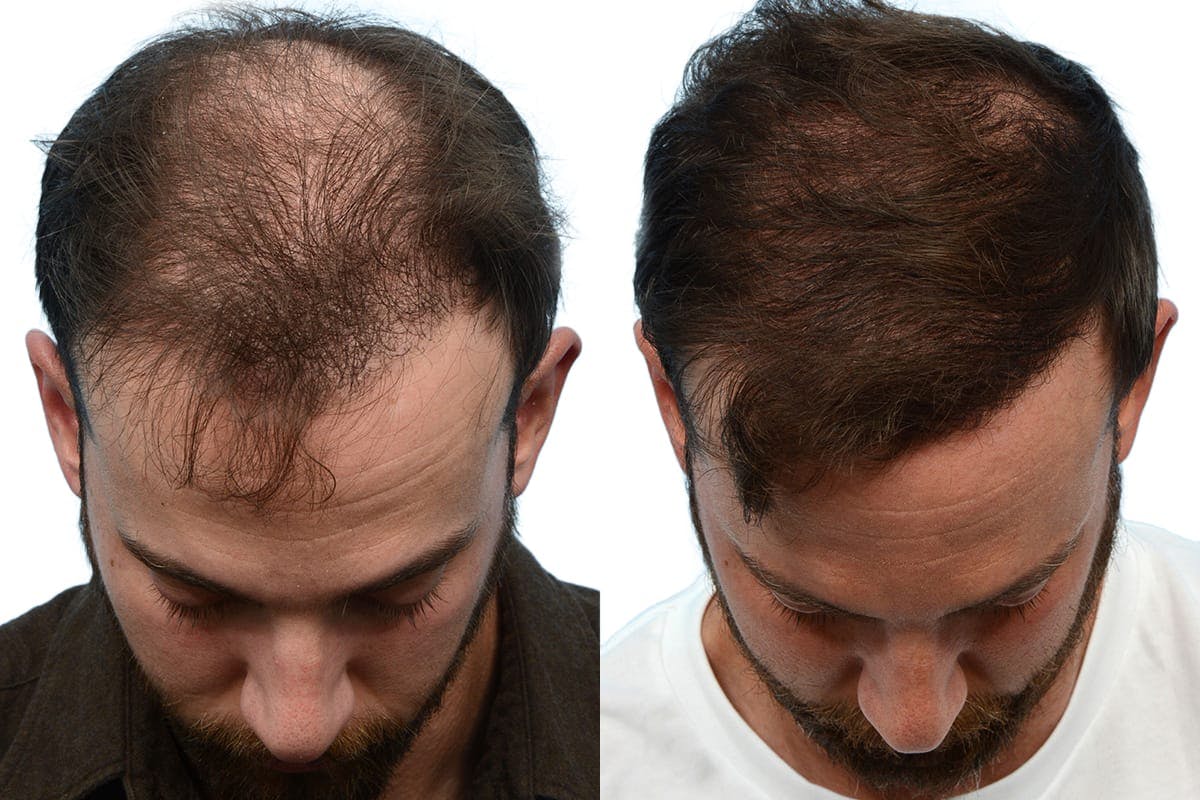 Hair Restoration Before & After Gallery - Patient 368855 - Image 2