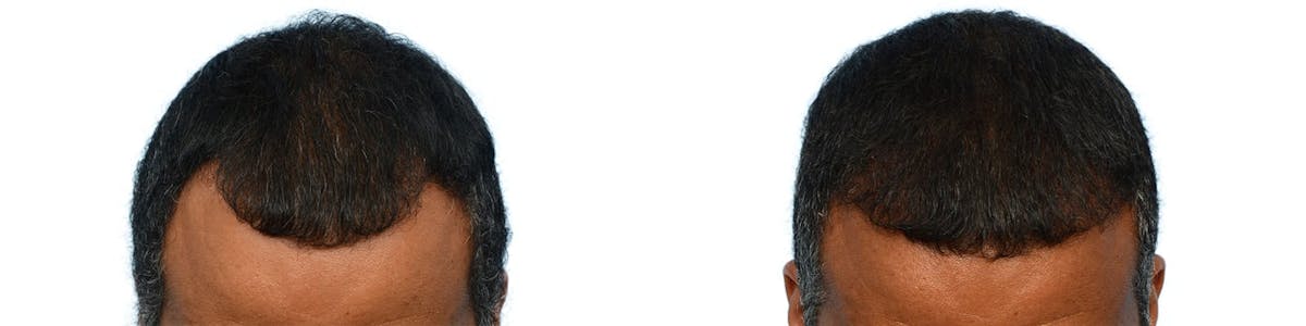 FUE Hair Transplant Before & After Gallery - Patient 332220 - Image 1