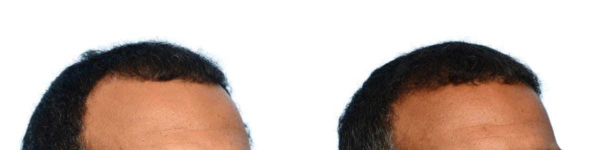 FUE Hair Transplant Before & After Gallery - Patient 332220 - Image 2