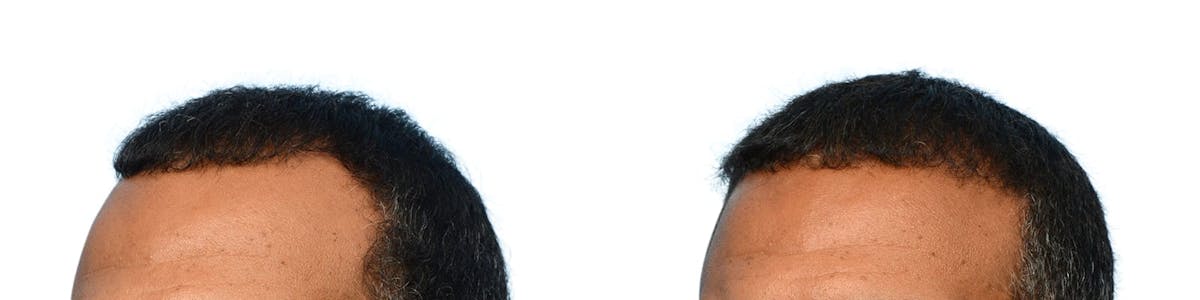 FUE Hair Transplant Before & After Gallery - Patient 332220 - Image 3