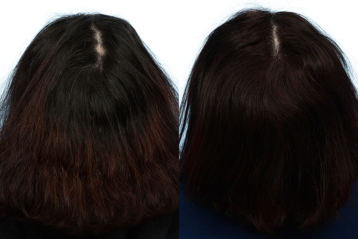Hair Restoration Before & After Gallery - Patient 261241 - Image 2