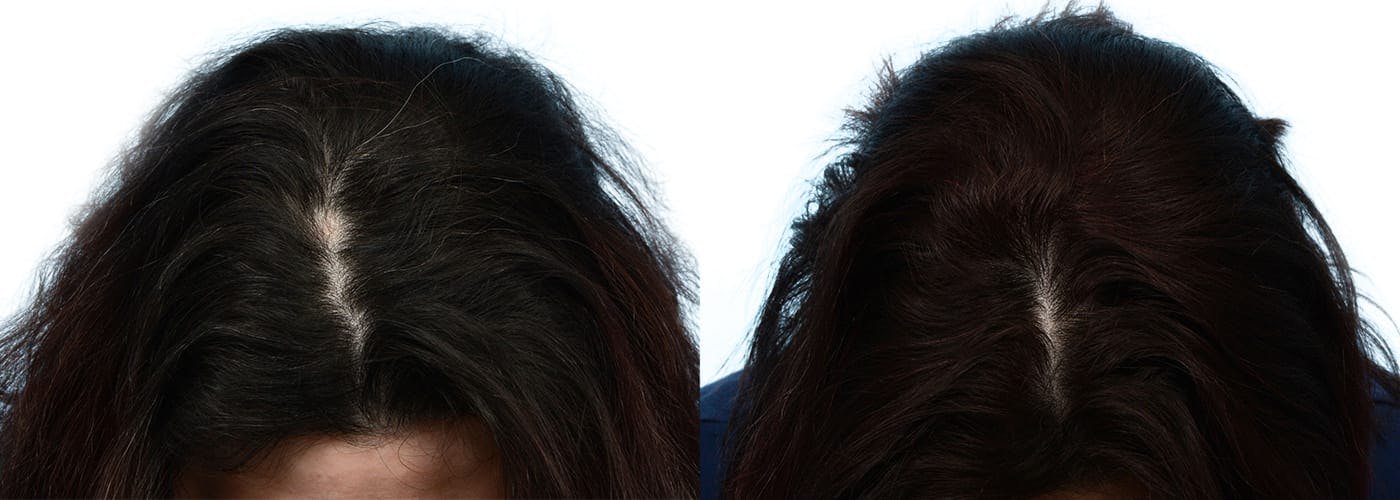 Hair Restoration  Before & After Gallery - Patient 261241 - Image 1