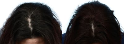 Female Hair Restoration Before & After Gallery - Patient 228445 - Image 1