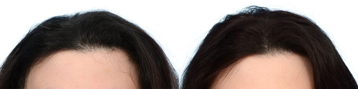Hair Restoration Before & After Gallery - Patient 261241 - Image 3
