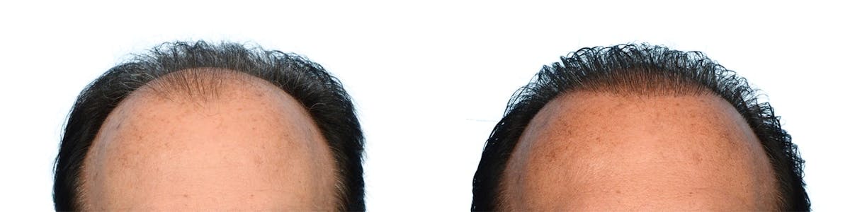 FUE Hair Transplant Before & After Gallery - Patient 176444 - Image 1