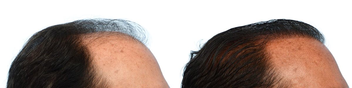FUE Hair Transplant Before & After Gallery - Patient 176444 - Image 2