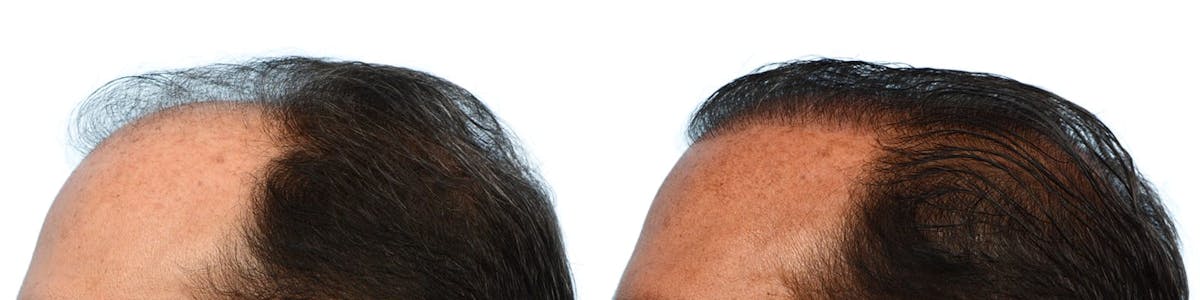 FUE Hair Transplant Before & After Gallery - Patient 176444 - Image 3