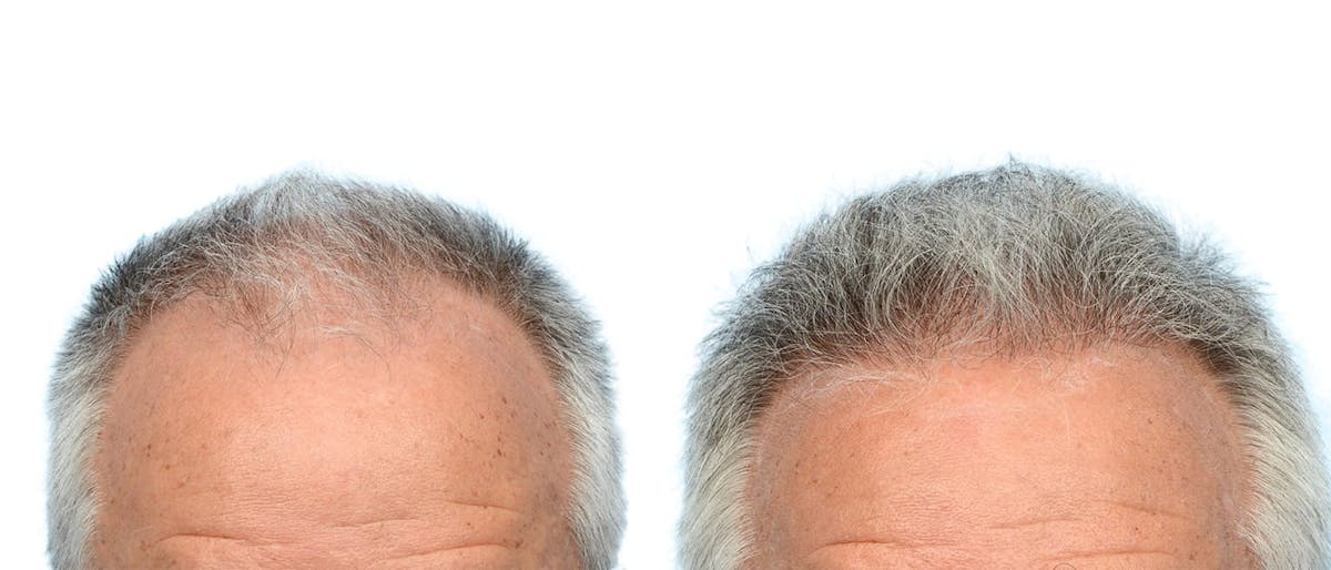 Hair Restoration Before & After Gallery - Patient 370622 - Image 1