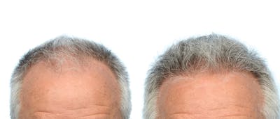 Hair Restoration Before & After Gallery - Patient 370622 - Image 1