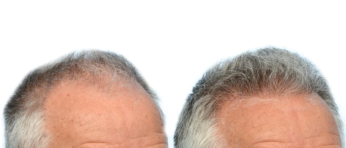 Hair Restoration Before & After Gallery - Patient 370622 - Image 2