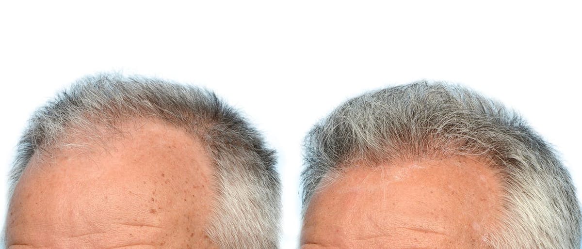 Hair Restoration Before & After Gallery - Patient 370622 - Image 3