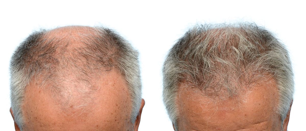 Hair Restoration Before & After Gallery - Patient 370622 - Image 4