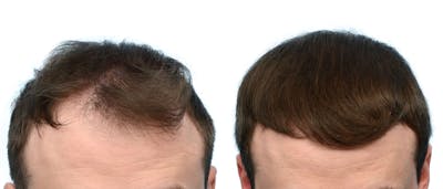 FUE Hair Transplant Before & After Gallery - Patient 308292 - Image 1