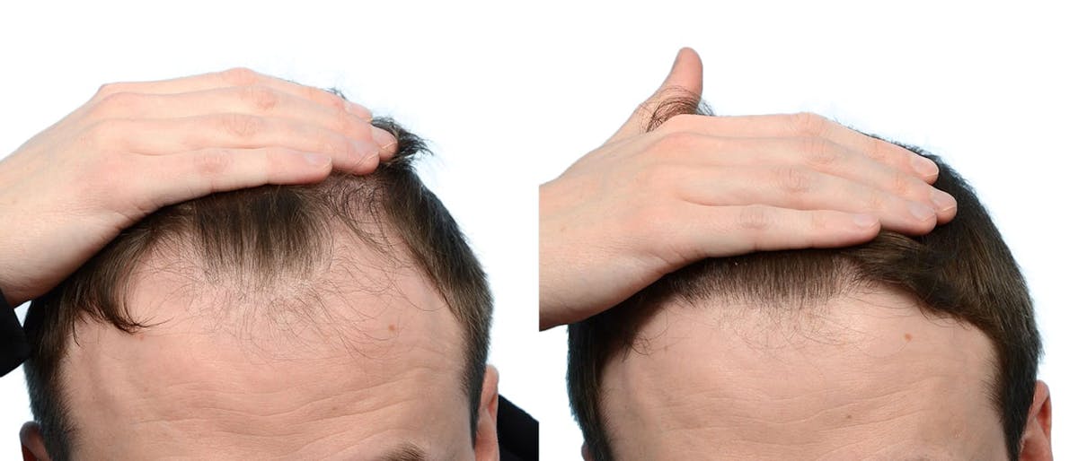 Hair Restoration Before & After Gallery - Patient 133434 - Image 2