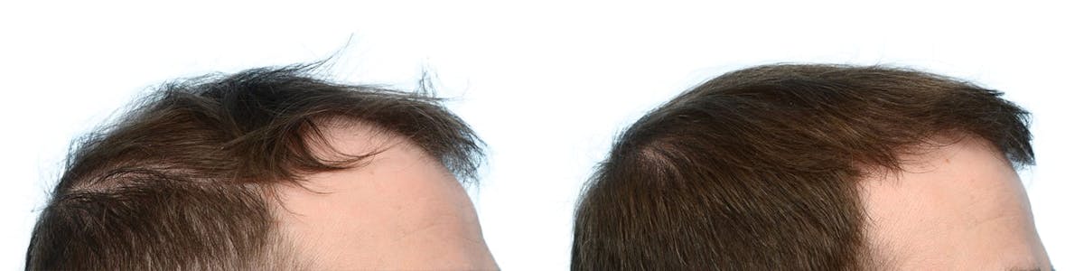 FUE Hair Transplant Before & After Gallery - Patient 308292 - Image 3