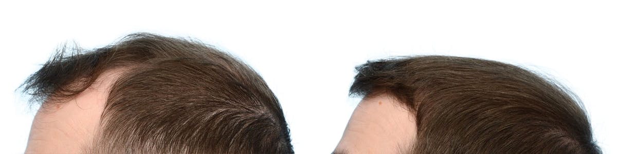 Hair Restoration Before & After Gallery - Patient 133434 - Image 4