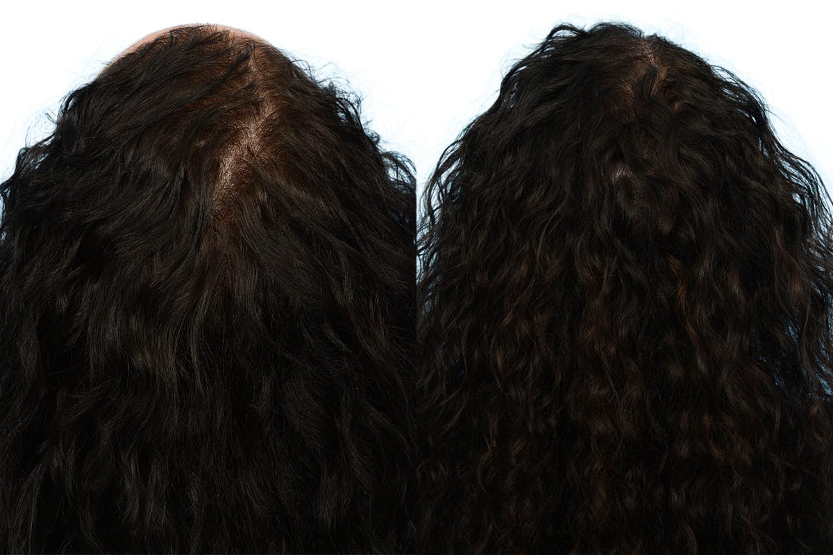 Female Hair Restoration Before & After Gallery - Patient 214766 - Image 2