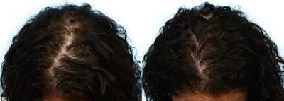 Female Hair Restoration Before & After Gallery - Patient 214766 - Image 1