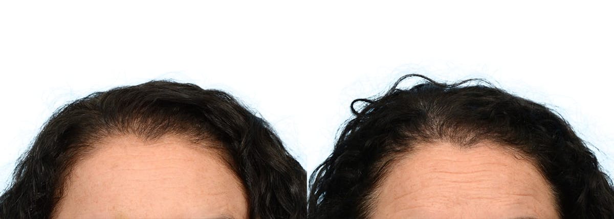 Female Hair Restoration Before & After Gallery - Patient 214766 - Image 3