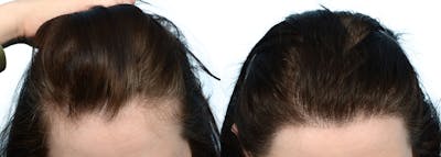 Female Hair Restoration Before & After Gallery - Patient 518985 - Image 1