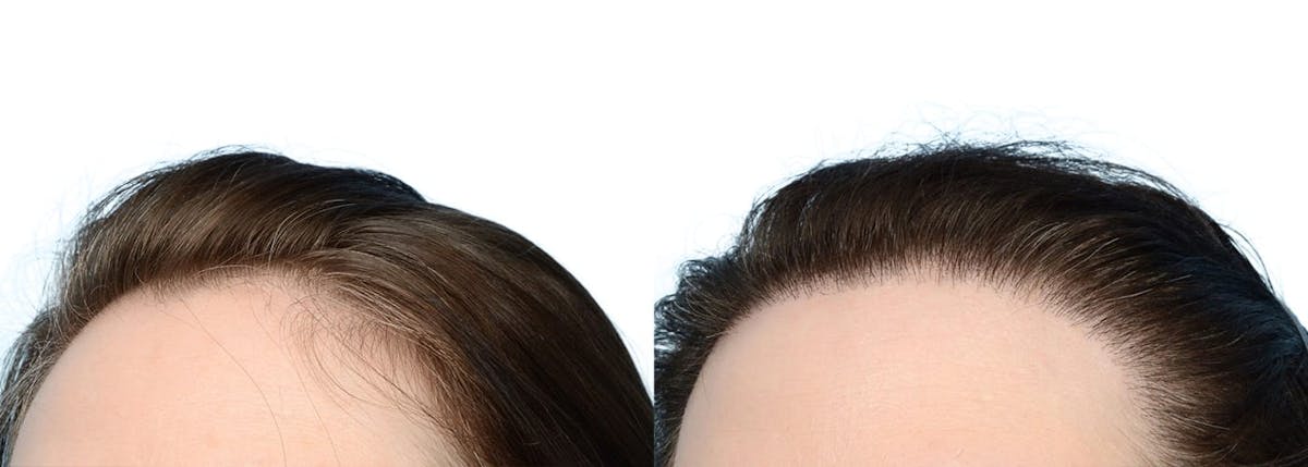 FUT Hair Transplant Before & After Gallery - Patient 557626 - Image 2