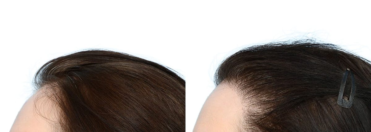 Hair Restoration Before & After Gallery - Patient 358580 - Image 3