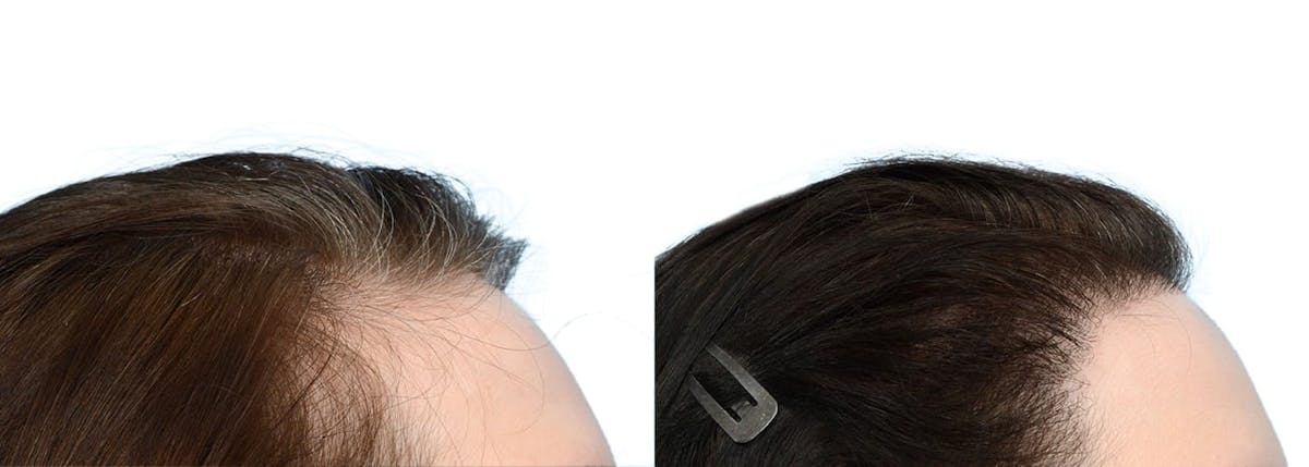 Female Hair Restoration Before & After Gallery - Patient 518985 - Image 4