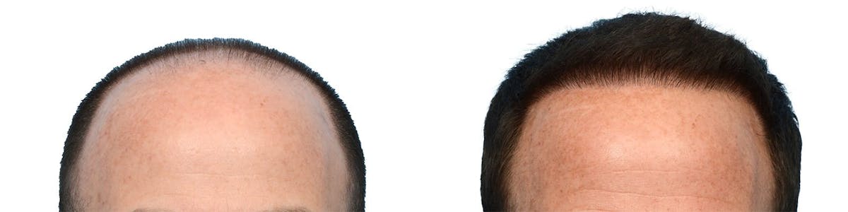 FUE Hair Transplant Before & After Gallery - Patient 906332 - Image 1