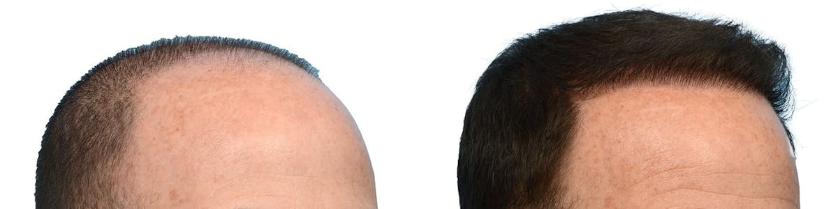 Hair Restoration Before & After Gallery - Patient 329372 - Image 2