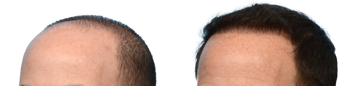 Hair Restoration Before & After Gallery - Patient 329372 - Image 3