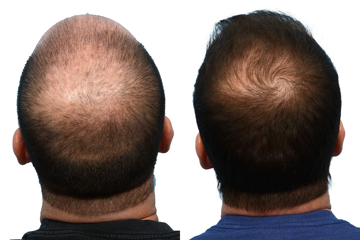 Hair Restoration Before & After Gallery - Patient 329372 - Image 4