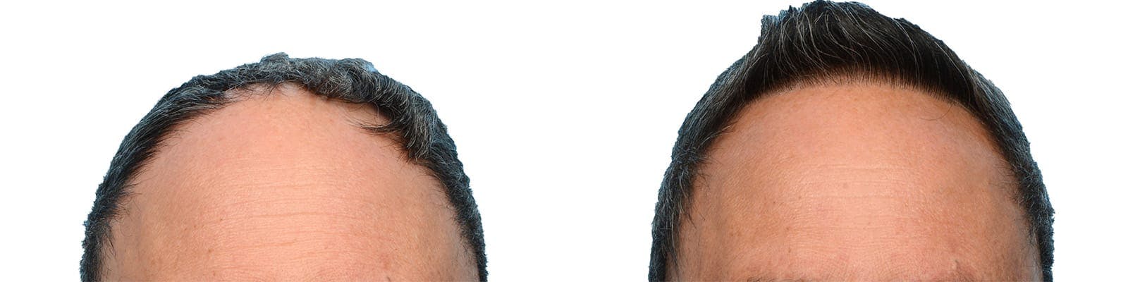 Hair Restoration  Before & After Gallery - Patient 342578 - Image 1