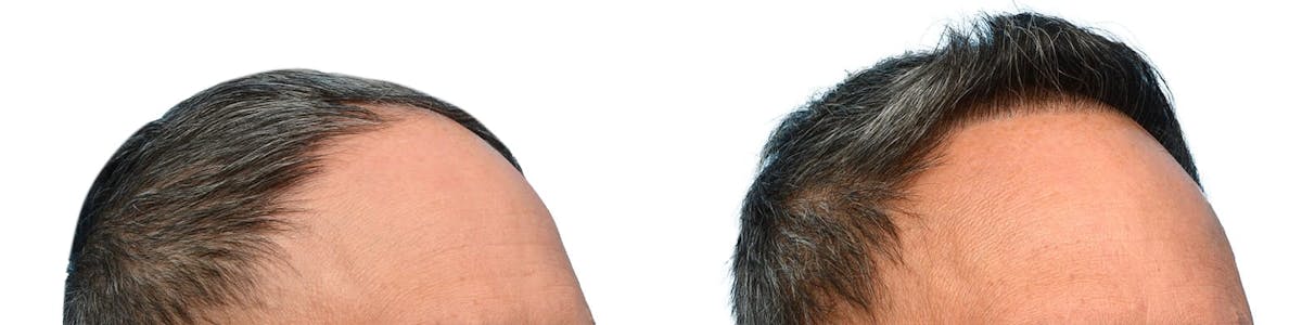 Hair Restoration Before & After Gallery - Patient 342578 - Image 2