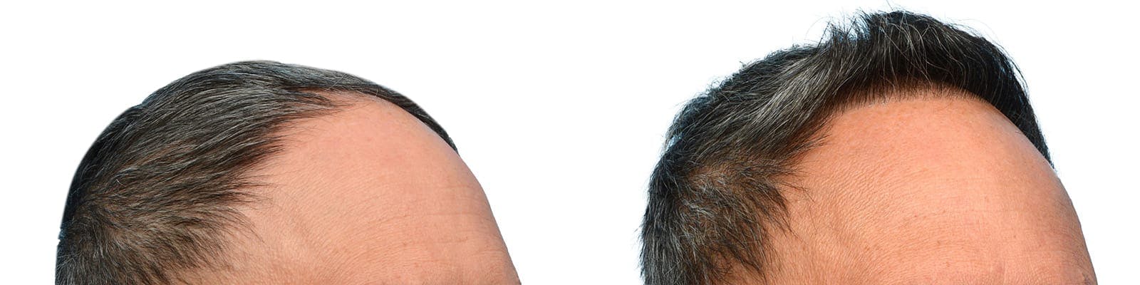 Hair Restoration  Before & After Gallery - Patient 342578 - Image 2