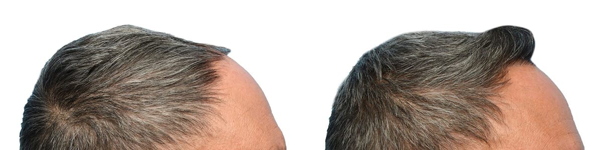 FUE Hair Transplant Before & After Gallery - Patient 423190 - Image 3