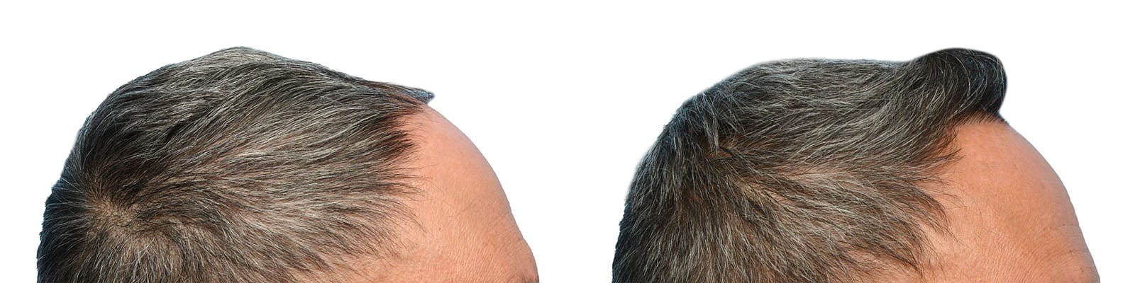 Hair Restoration  Before & After Gallery - Patient 342578 - Image 3