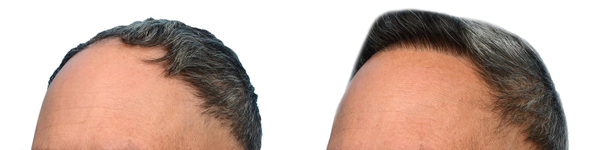 Hair Restoration Before & After Gallery - Patient 342578 - Image 4