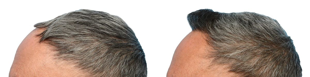 Hair Restoration Before & After Gallery - Patient 342578 - Image 5