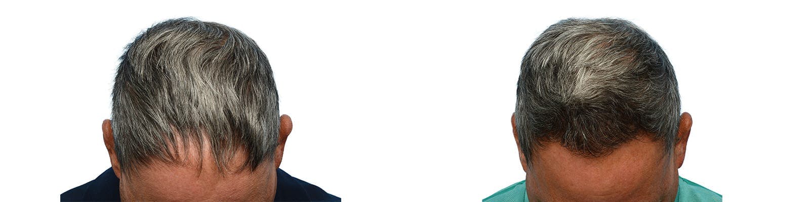 Hair Restoration  Before & After Gallery - Patient 342578 - Image 6