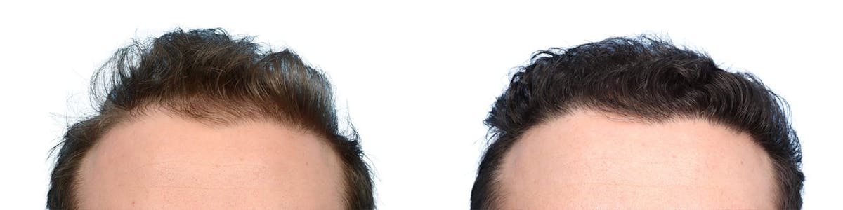 FUE Hair Transplant Before & After Gallery - Patient 118592 - Image 1