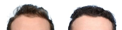 FUE Hair Transplant Before & After Gallery - Patient 118592 - Image 1