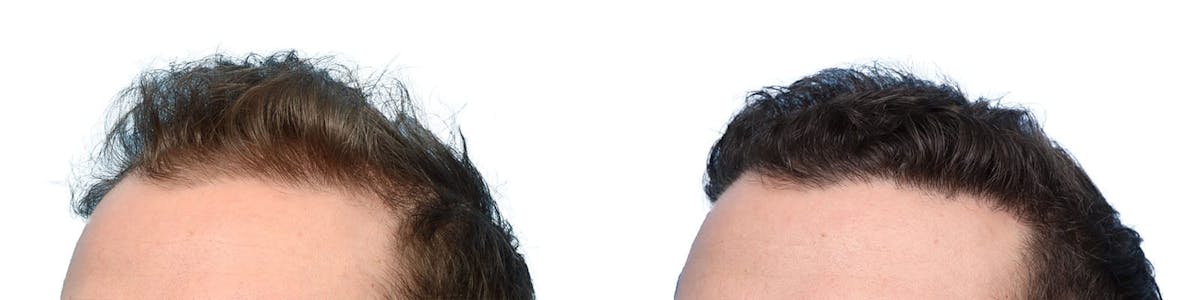 Hair Restoration Before & After Gallery - Patient 224007 - Image 2