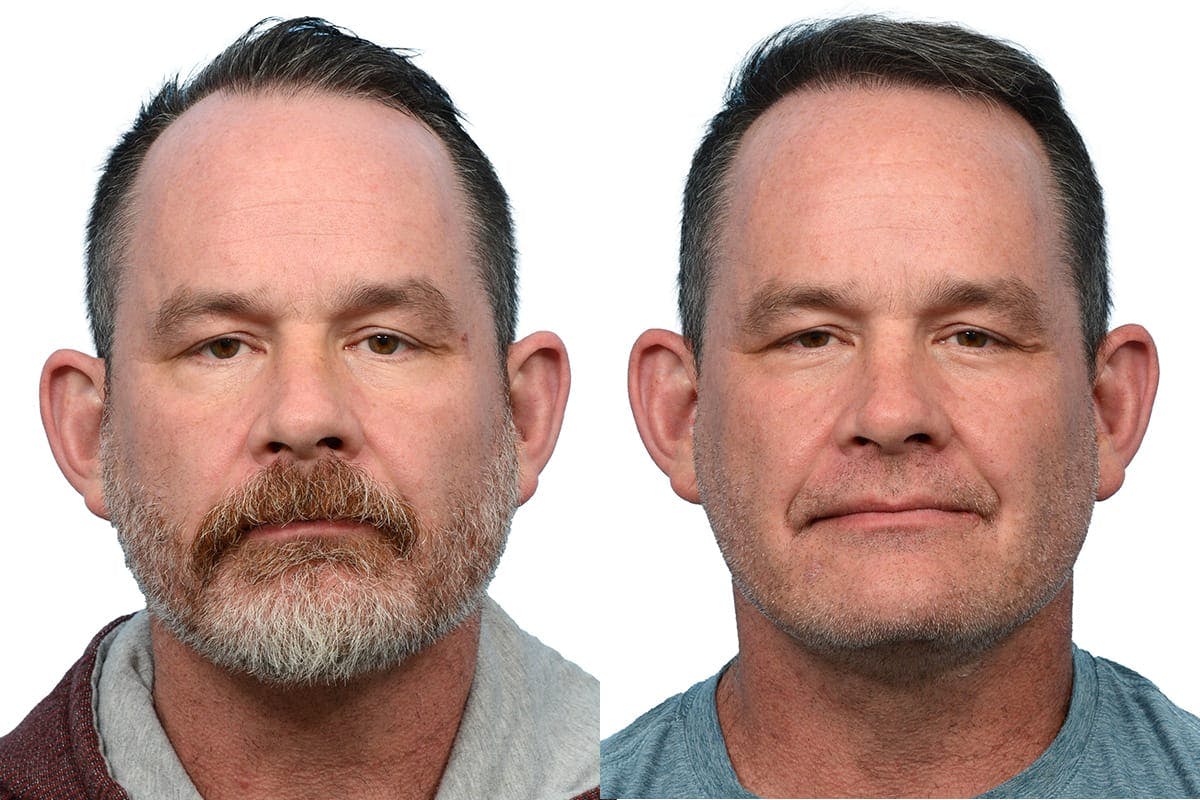 Hair Restoration Before & After Gallery - Patient 426609 - Image 1
