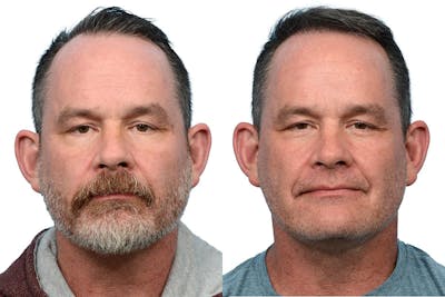 Hair Restoration Before & After Gallery - Patient 426609 - Image 1
